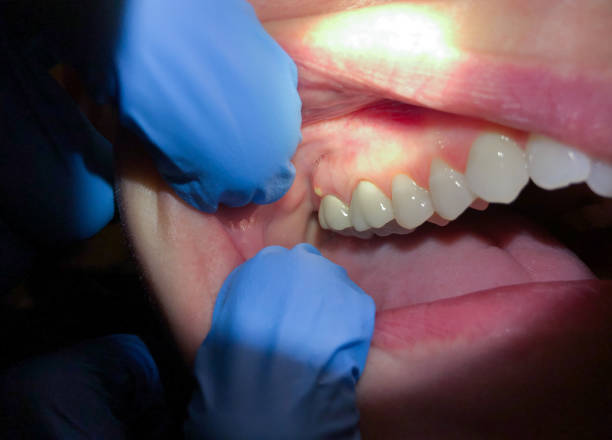 Best Knocked-Out Tooth (Avulsed Tooth) Treatment in Cleveland, GA